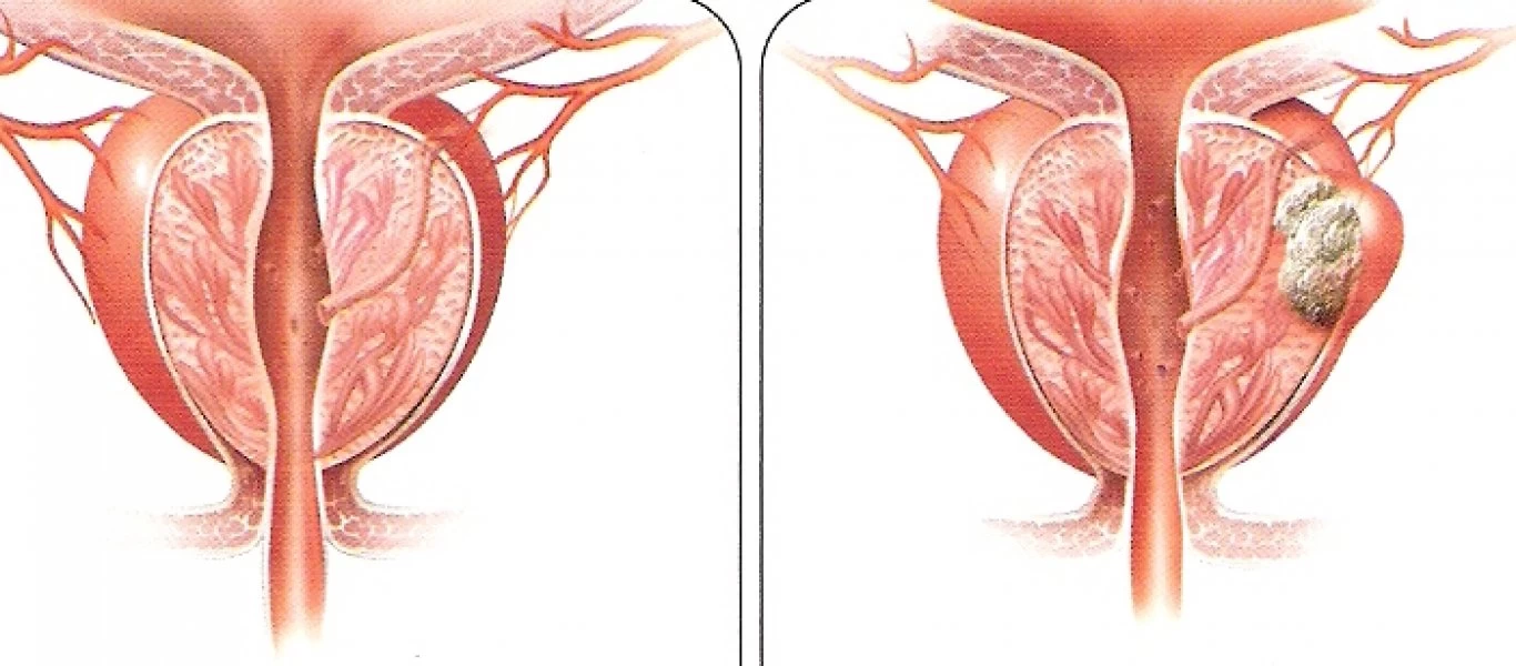 Νέο φάρμακο βοηθά στην ανάκαμψη της στύσης μετά από χειρουργείο αφαίρεσης προστάτη